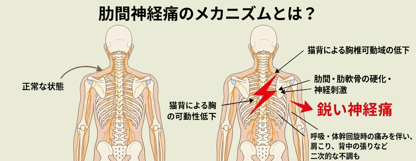 肋間神経と肋骨の関係を示した肋間神経痛の解説イラスト