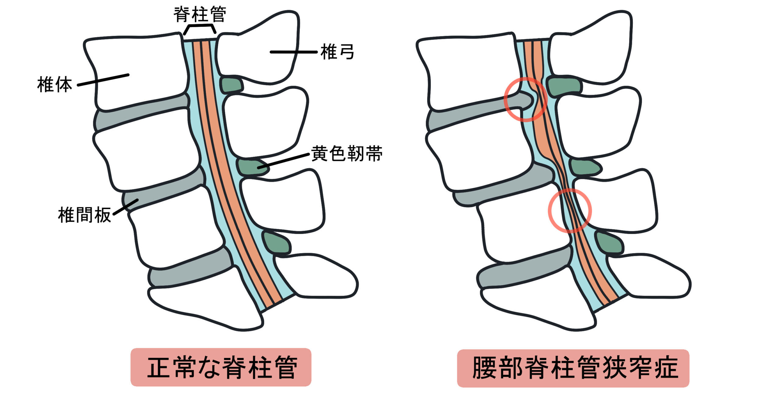 脊柱管狭窄症
